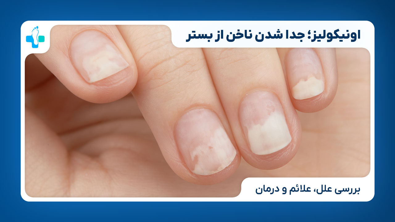 اونیکولیز؛ جدا شدن ناخن از بستر