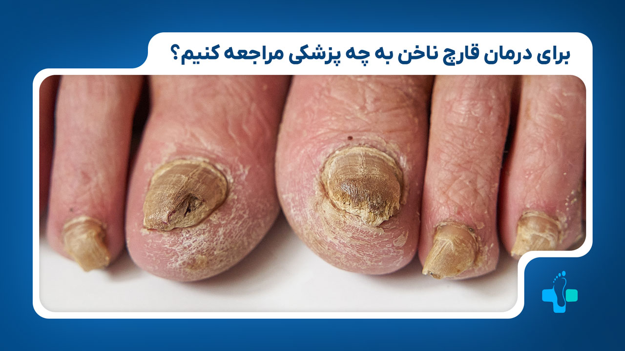 برای درمان قارچ ناخن به چه دکتری مراجعه کنیم؟؟