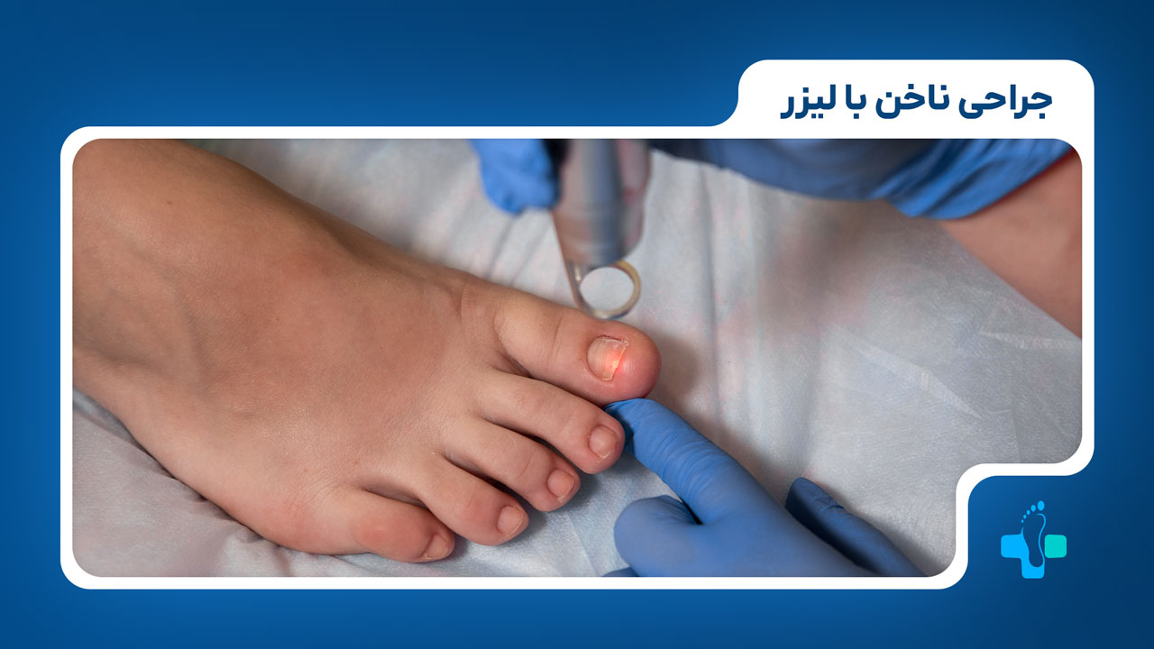 جراحی ناخن با روش لیزر