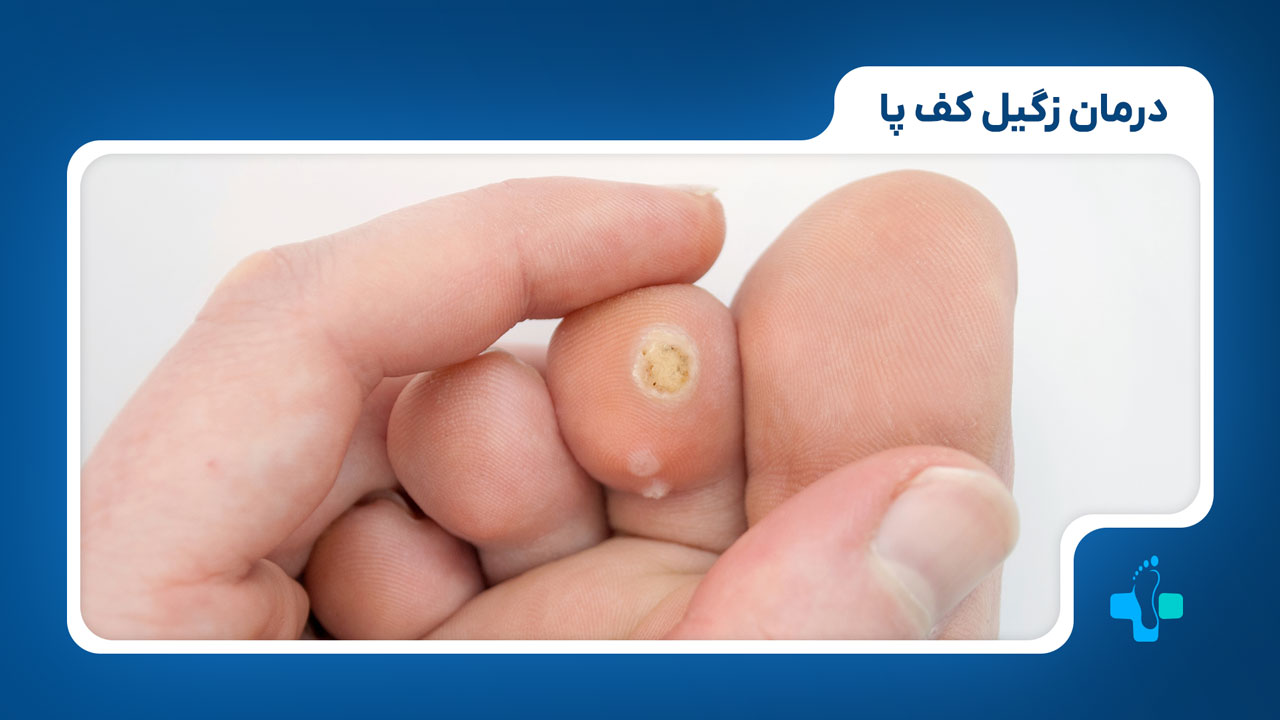 درمان برای زگیل کف پا