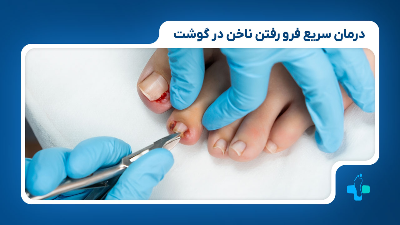 درمان سریع برای فرو رفتن ناخن در گوشت