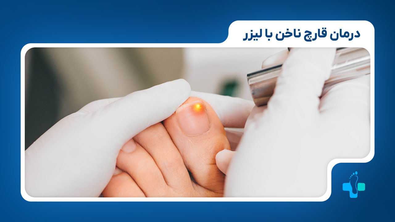 درمان لیزر برای قارچ ناخن