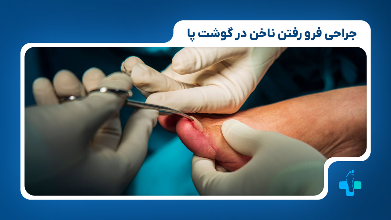 جراحی فرو رفتن ناخن در گوشت پا