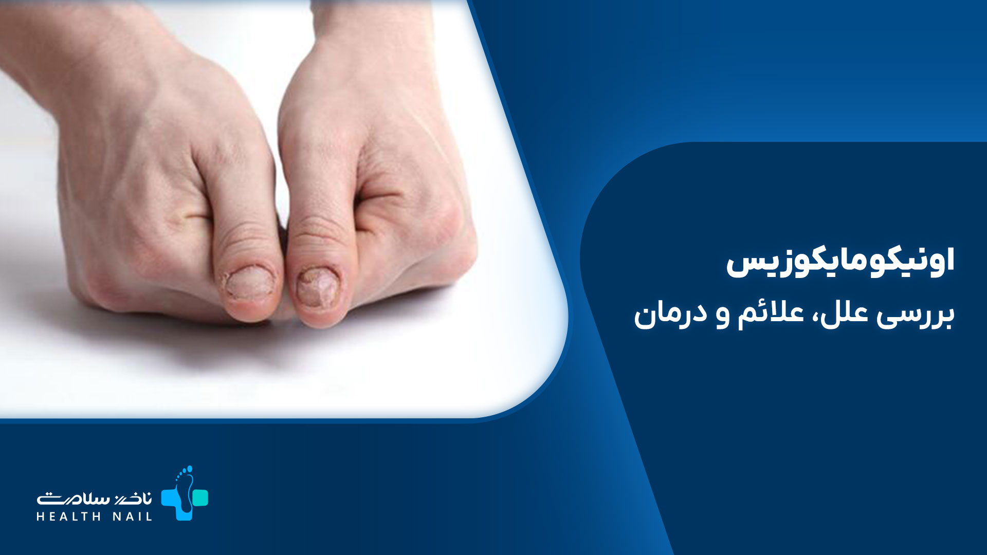 بیماری اونیکومایکوزیس