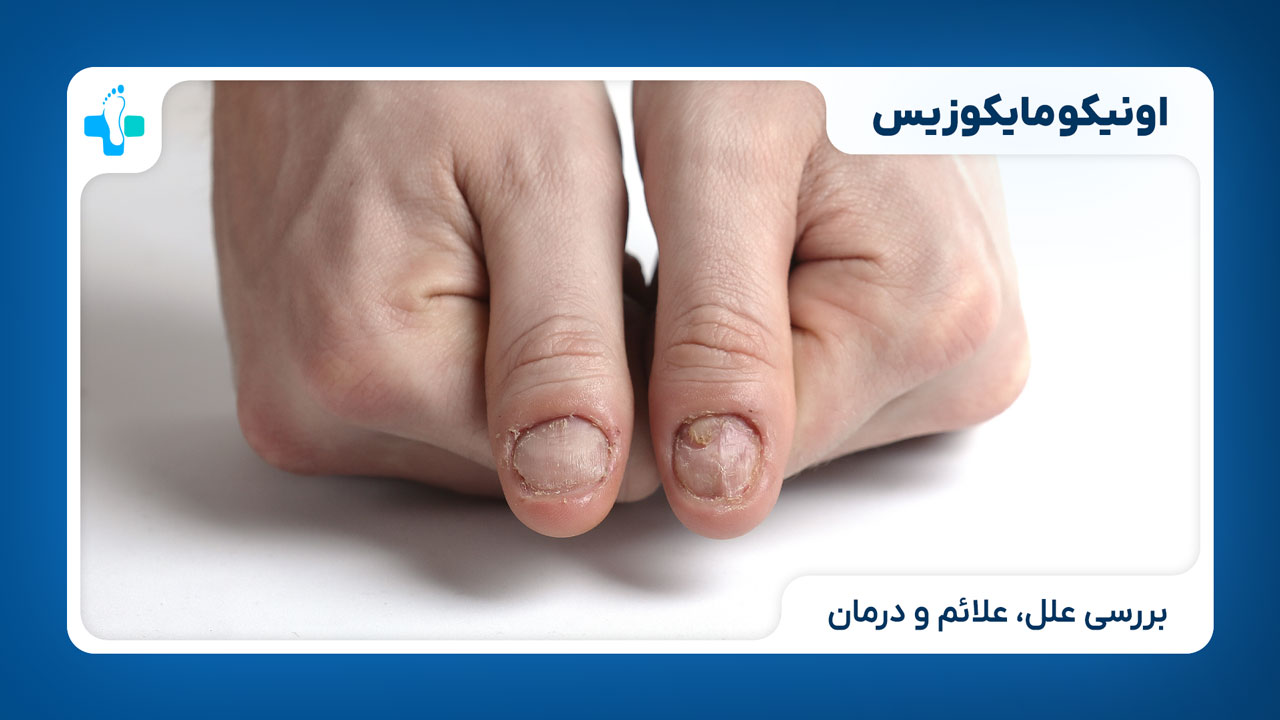 بیماری اونیکومایکوزیس