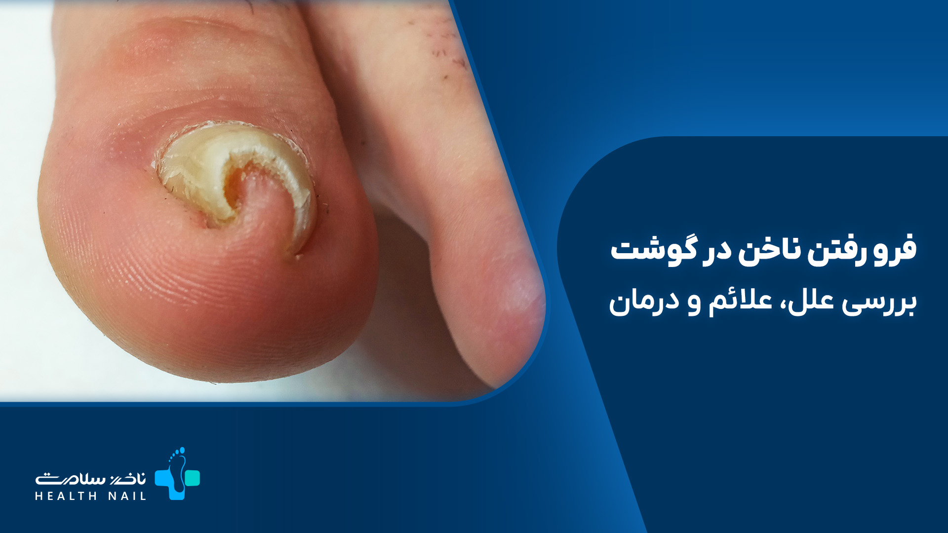 بیماری فرو رفتن ناخن در گوشت