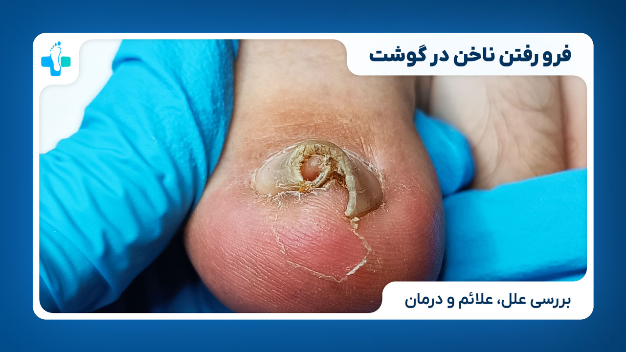 بیماری فرو رفتن ناخن در گوشت