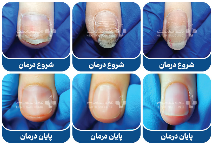 عکس قارچ ناخن دست