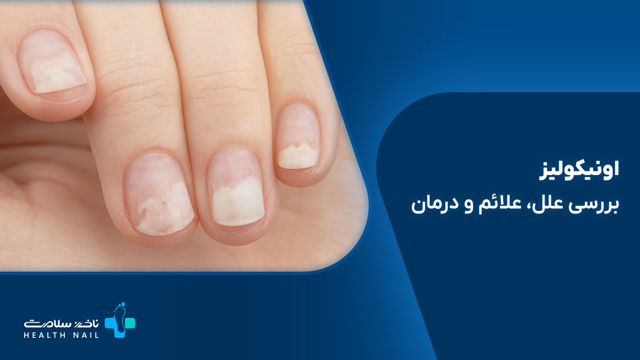 اونیکولیز؛ جدا شدن ناخن از بستر