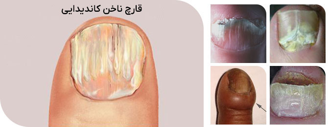 قارچ ناخن کاندیدا