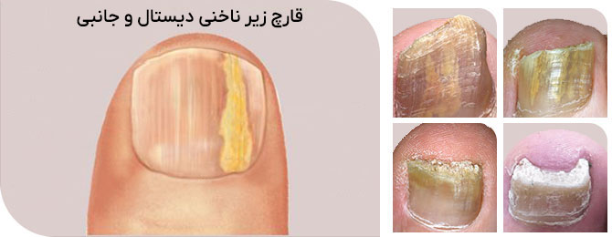 قارچ زیر ناخنی دیستال و جانبی