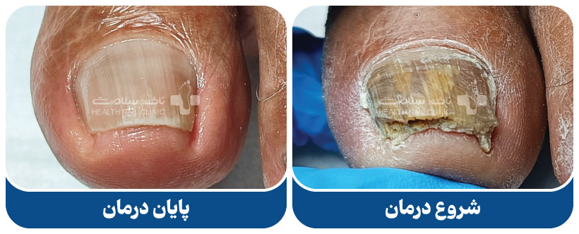 درمان سریع قارچ ناخن