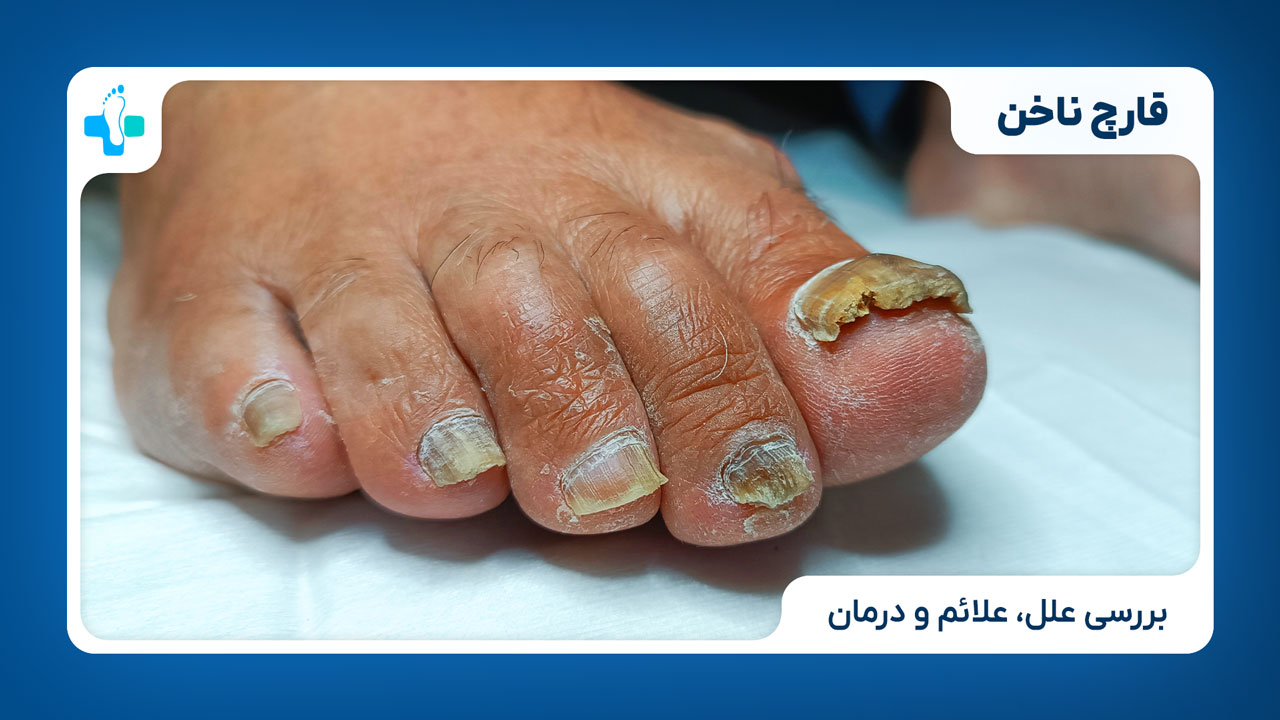 قارچ ناخن
