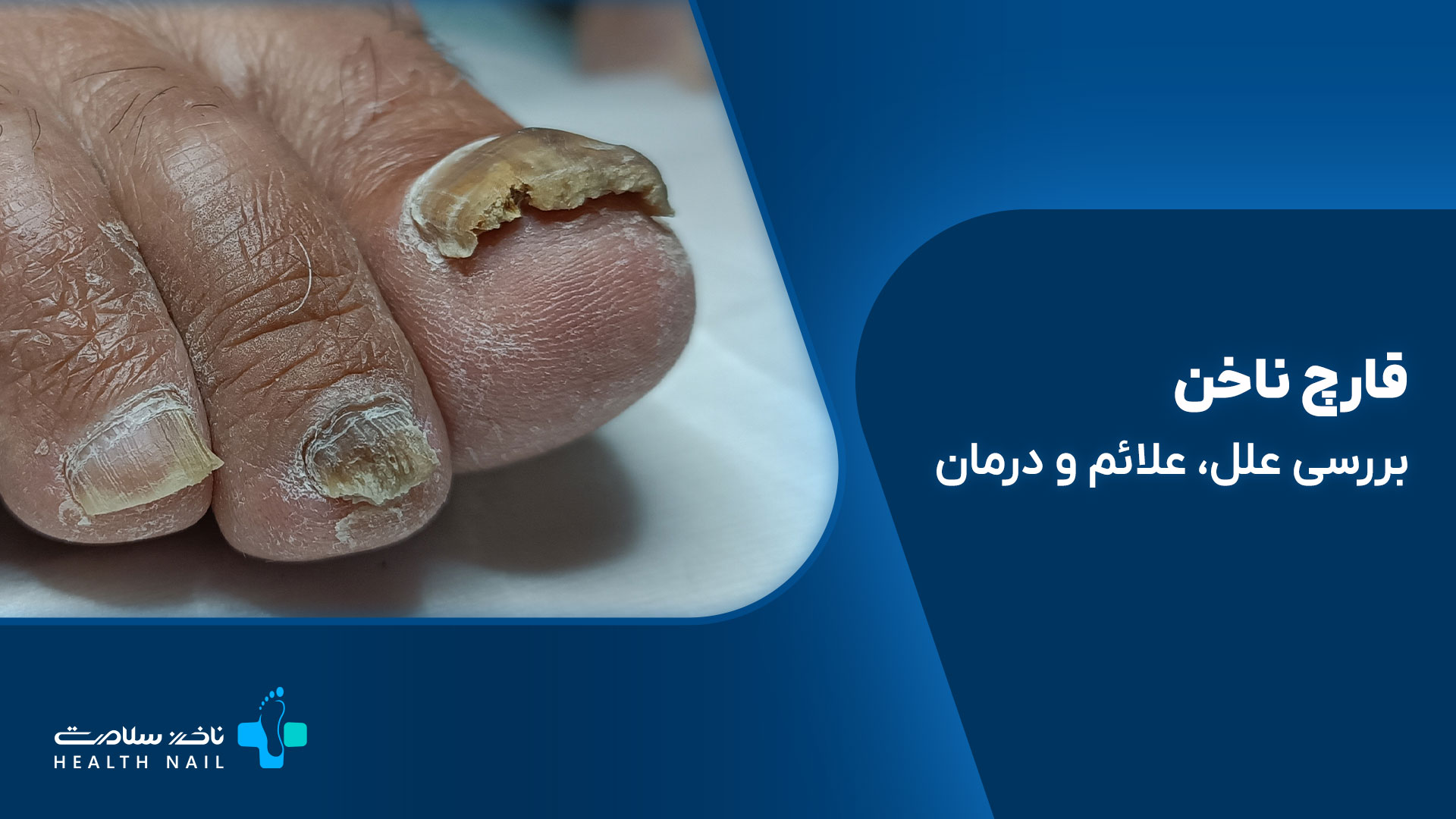 قارچ ناخن