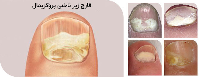 قارچ زیر ناخنی پروگزیمال
