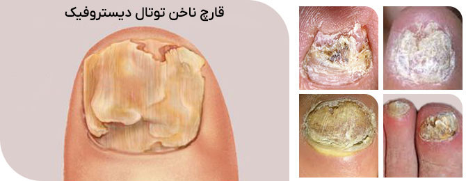 قارچ ناخن توتال دیستروفیک