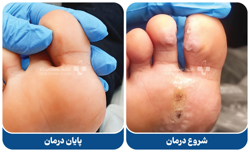 درمان زگیل پا با کرایوتراپی