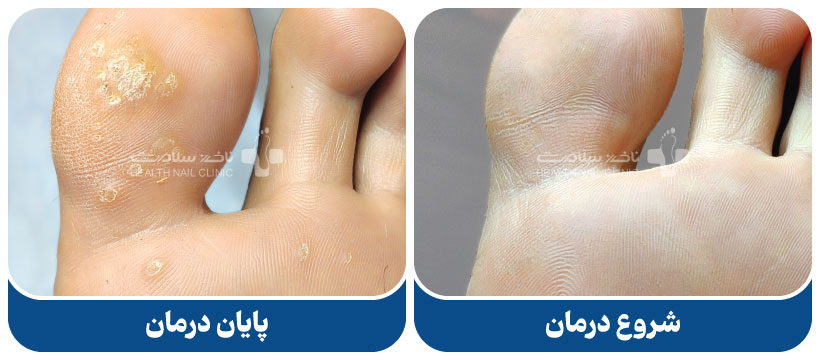درمان با فریز کردن زگیل پا