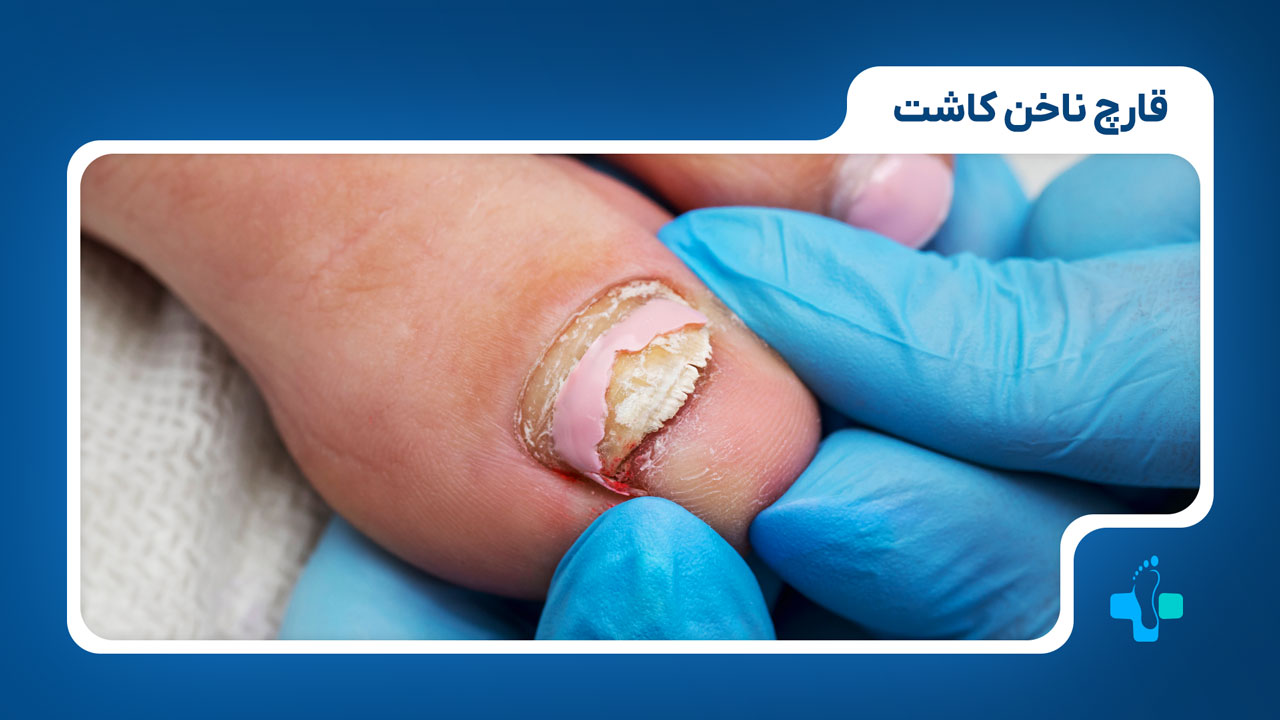 قارچ ناخن کاشت