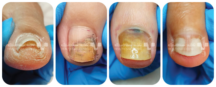 علائم قارچ ناخن کاشت