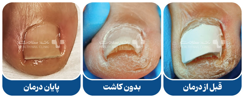 درمان قارچ ناخن کاشت