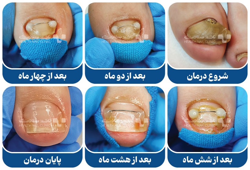 دبریدمان ناخن پا