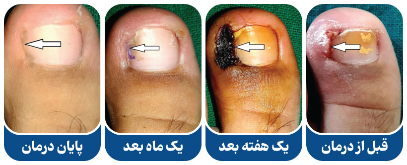 مراحل فنولیزه ناخن پا