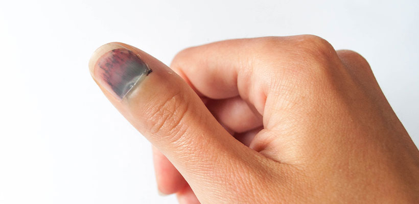 سیاه شدن ناخن پا