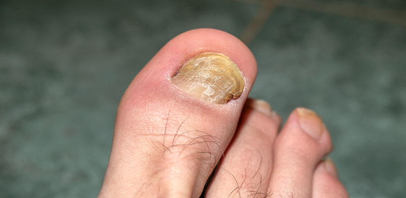 زرد شدن ناخن پا