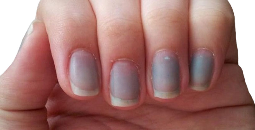 آبی شدن ناخن پا