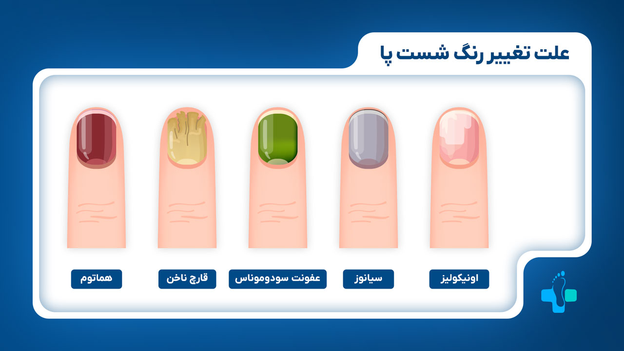 علت تغییر رنگ ناخن شست پا