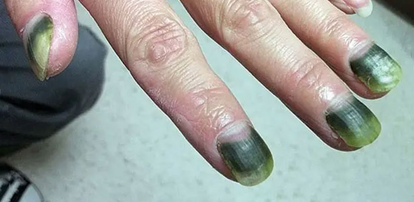 سبز شدن ناخن