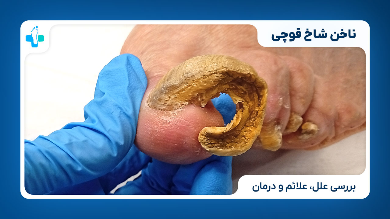 ناخن شاخ قوچی