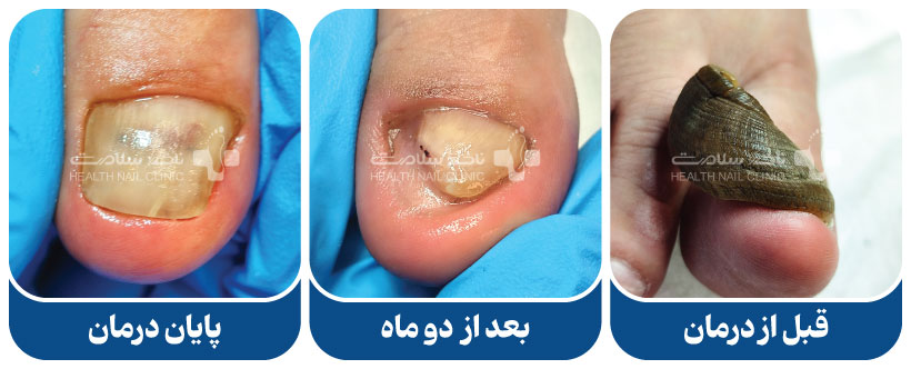 درمان ناخن شاخ قوچی