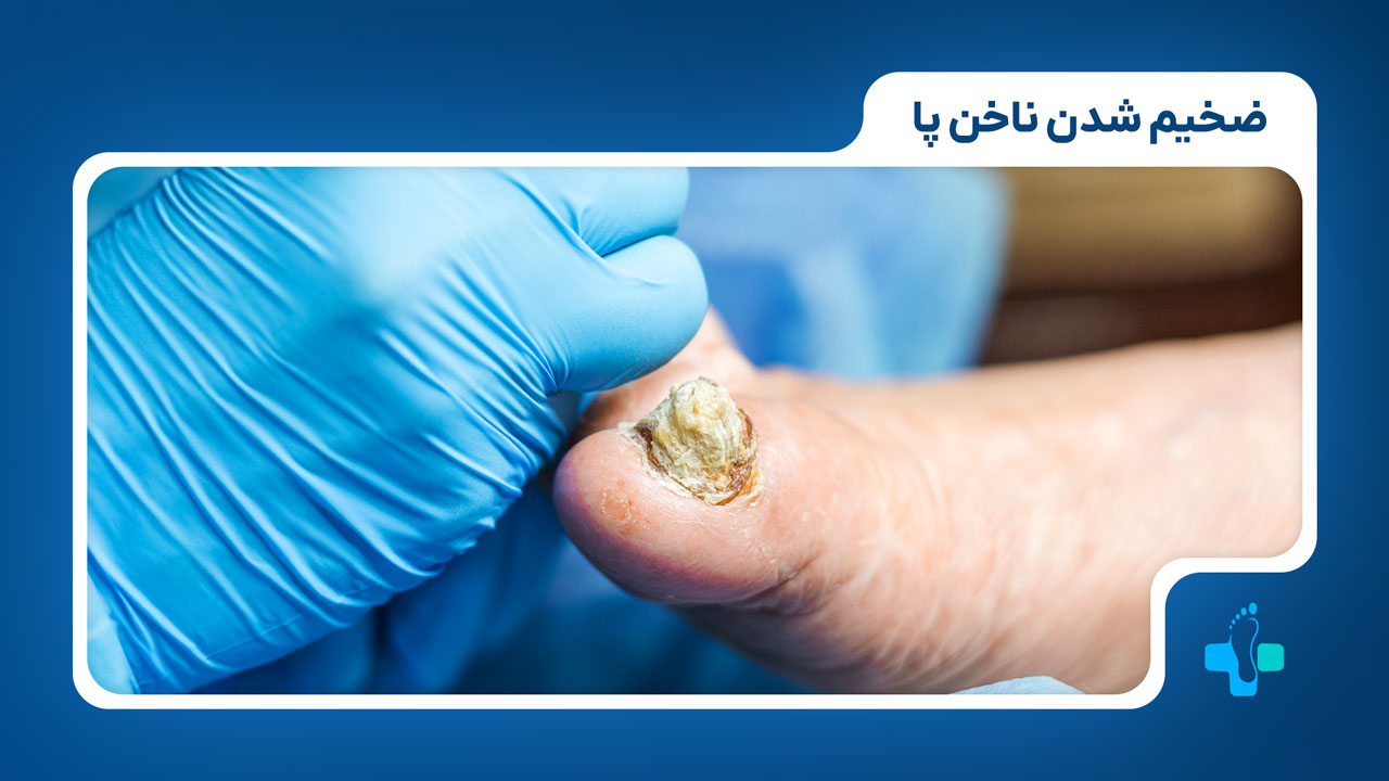 ضخیم شدن ناخن پا