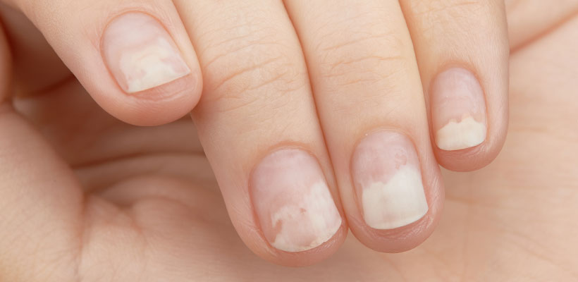 سفید شدن ناخن