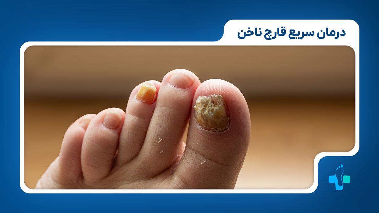 درمان سریع قارچ ناخن
