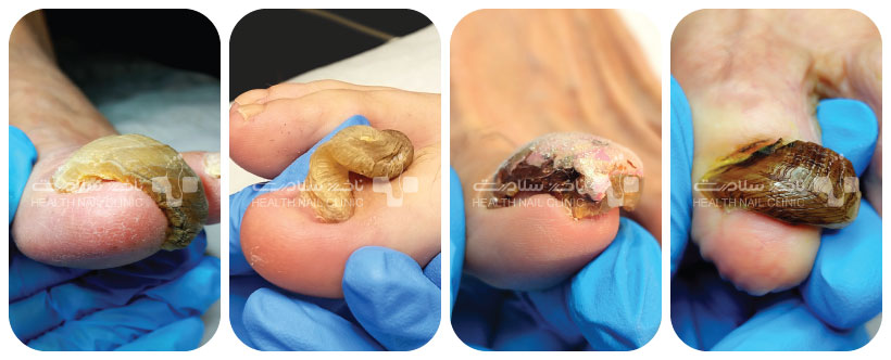 علائم ناخن شاخ قوچی
