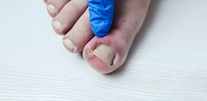 پارونیشیا شست پا