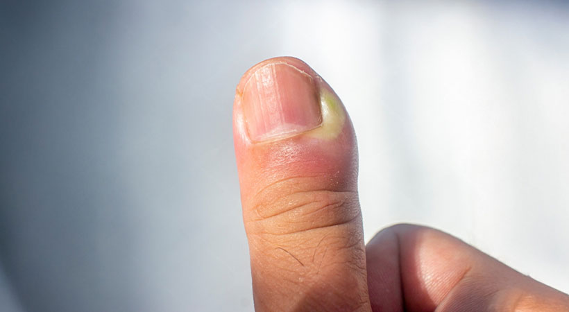 پارونیشیا شست دست