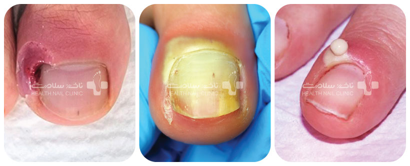علائم پارونیشیا