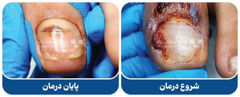 درمان پارونیشیا
