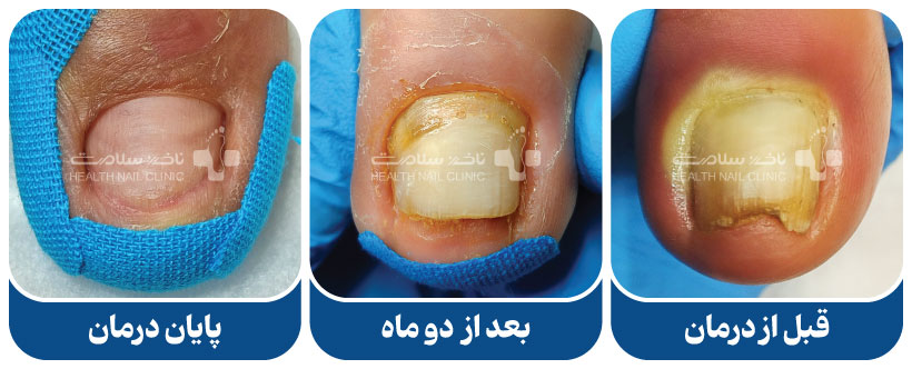ناخن بیمار درمان شده در کلینیک ناخن سلامت (تخلیه عفونت ناخن پا)