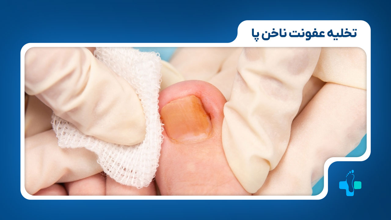 تخلیه عفونت ناخن پا