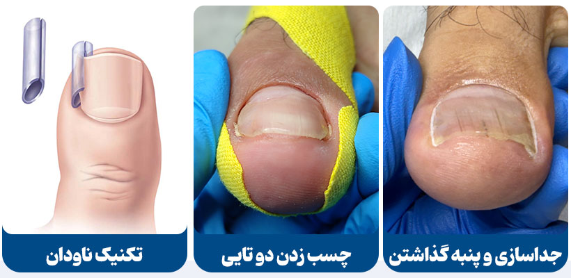 انواع روش درمان خانگی ناخن فرو رفته در گوشت