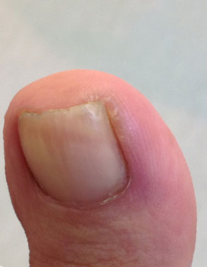 مرحله اول بیماری ناخن فرو رفته در گوشت فاز التهاب خفیف
