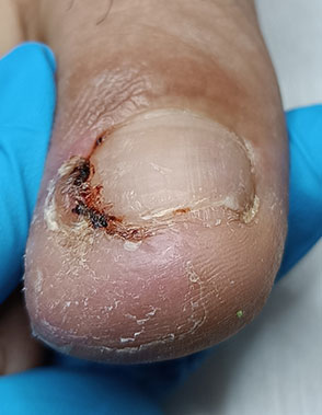 مرحله دوم بیماری ناخن فرو رفته در گوشت فاز حاد و عفونی