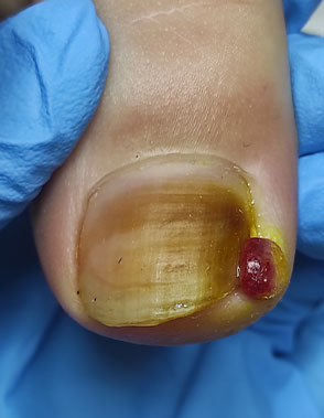 مرحله سوم بیماری ناخن فرو رفته در گوشت فاز مزمن و هایپرتروفی