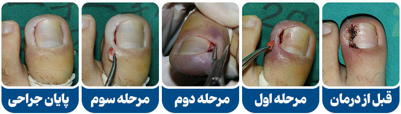 جراحی کناره ناخن