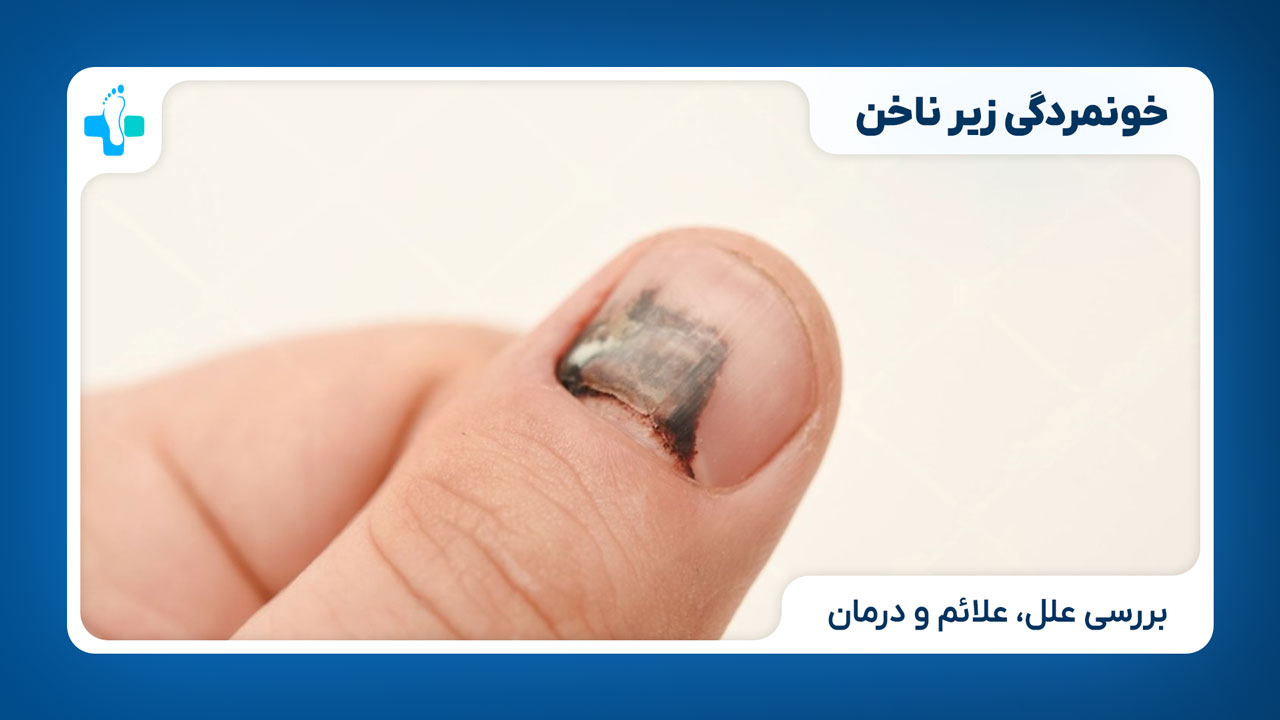 سیاه شدن ناخن (هماتوم زیر ناخن)